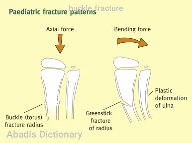 buckle fracture